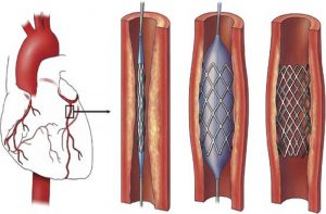 An illustration showing use of stents in the heart. Photo: Britannica