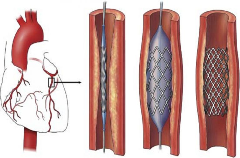Govt Acts to Rein in the ‘Business’ of stents