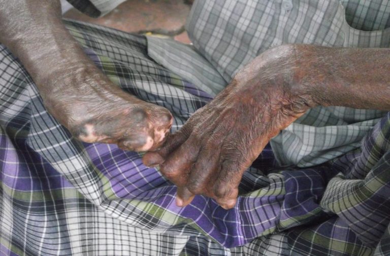 Discrimination against leprosy patients: Most states failed to state steps taken for rehabilitation, SC told