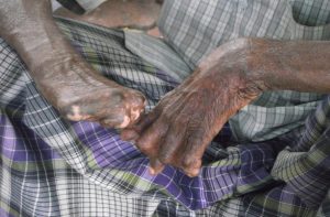 SC expresses displeasure over the non-implementation of programmes for leprosy patients