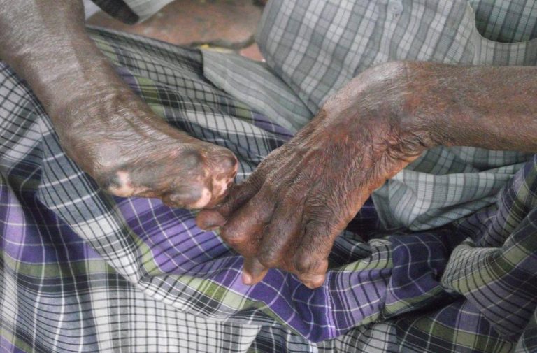 Bill to end discrimination against leprosy patients in next session of parliament, Centre tells SC