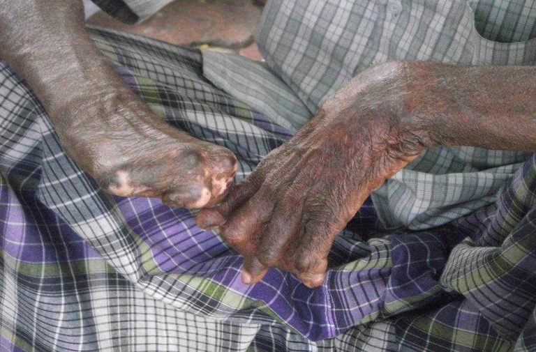 SC issues a slew of directives to Centre, states on the rehabilitation of leprosy affected persons