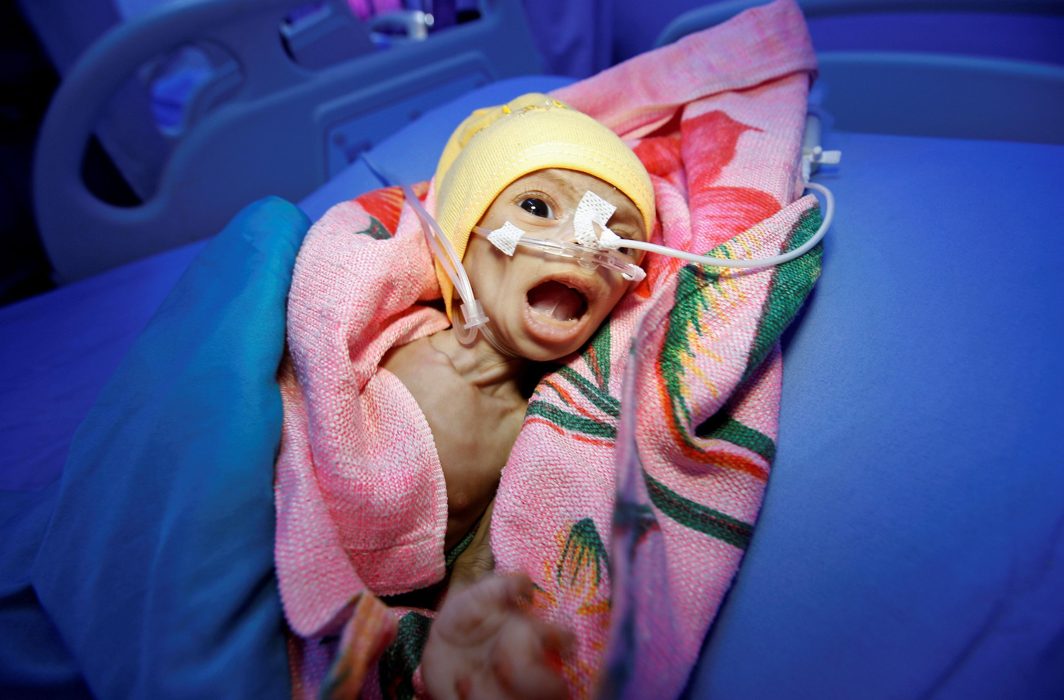 STRUGGLING: Sixty-day-old Nadia Ahmad Sabri, who suffers from severe malnutrition, lies in bed at a malnutrition treatment center in the Red Sea port city of Hodeida, Yemen, Reuters/UNI