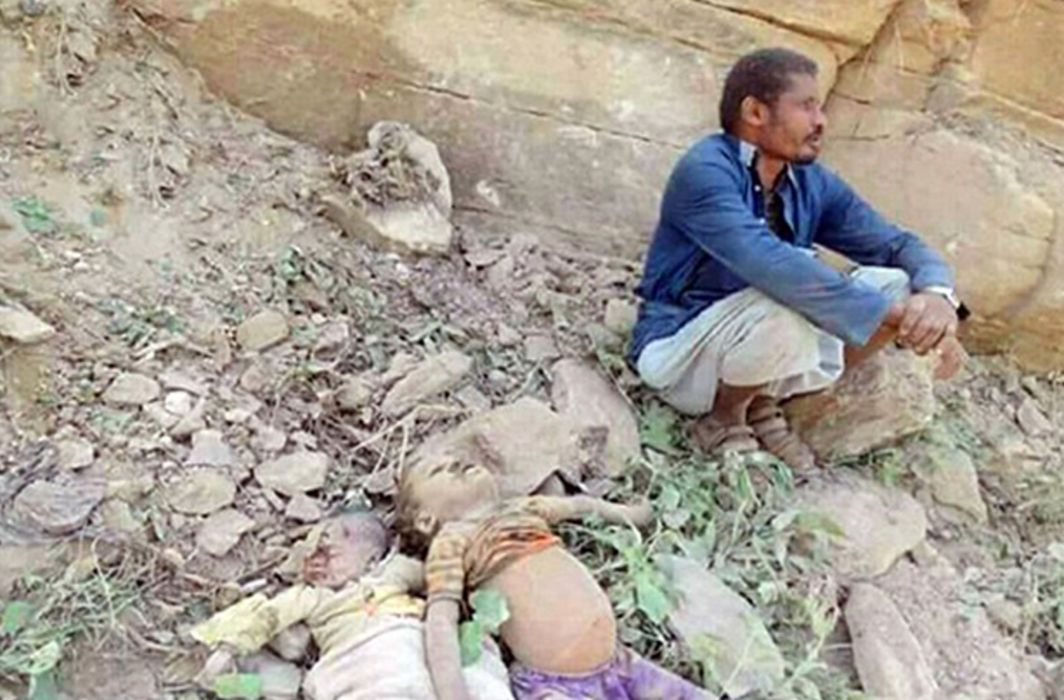 Yemen; Children Face Death, Malnutrition, forced to eat wax leaves