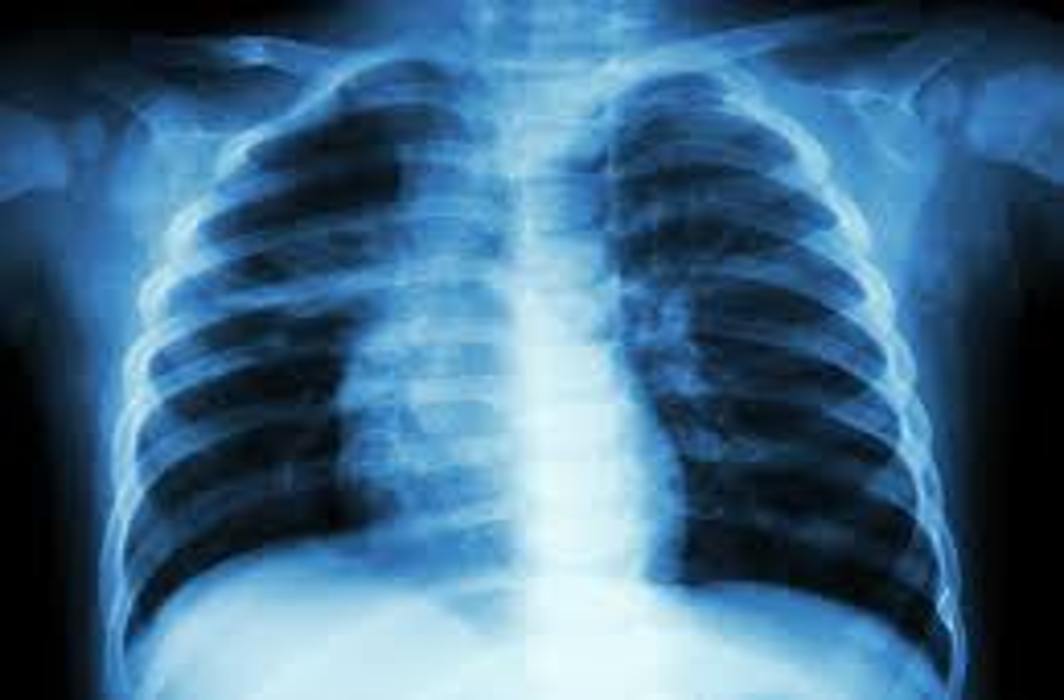 World Tuberculosis Day 2022