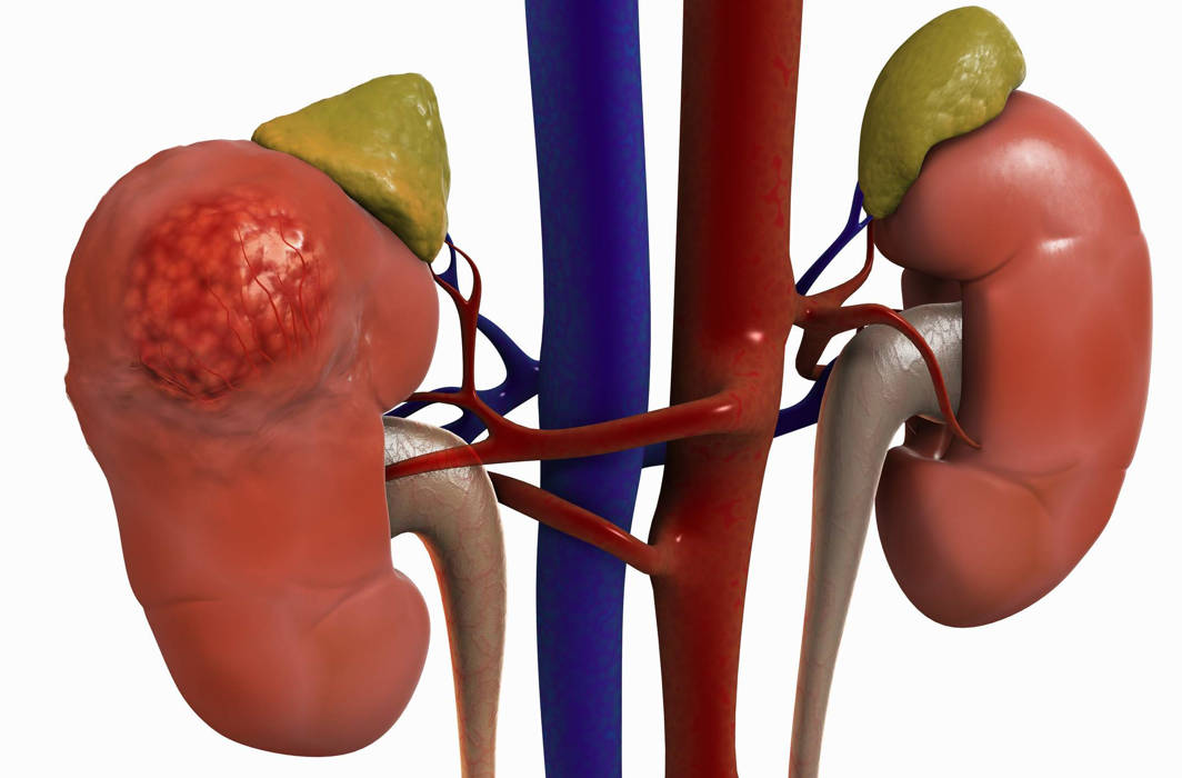 Excessive use of Vitamin D may lead to Kidney failure