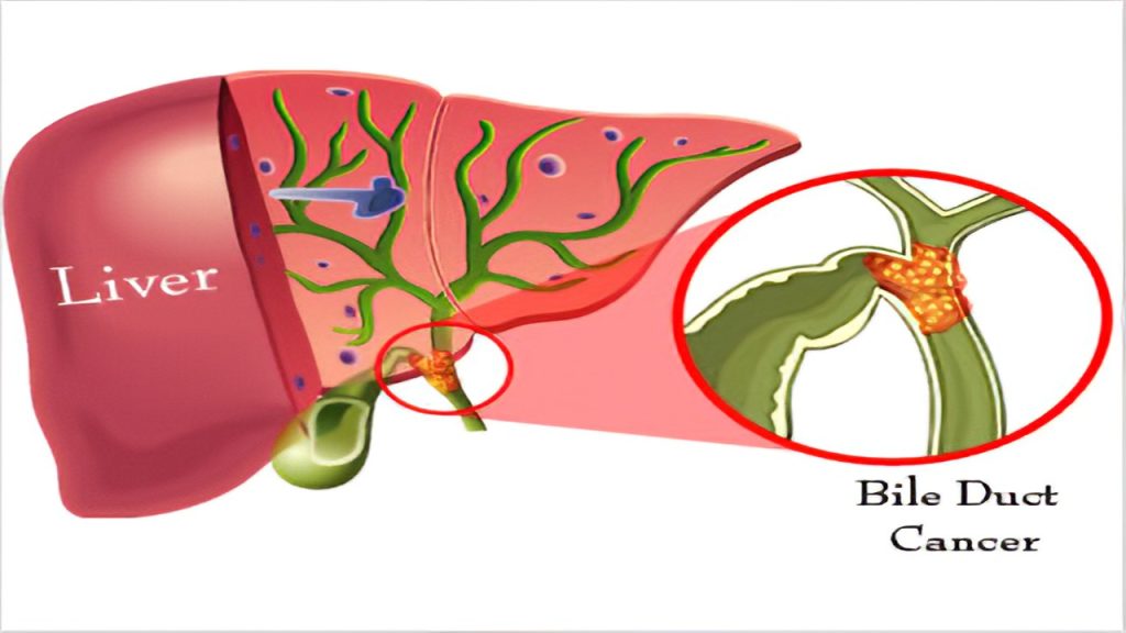 What Is Bile Duct Cancer Symptoms Stages And When Do You Need To Visit Doctor Heres What 2792