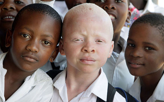 International Albinism Awareness Day 2022