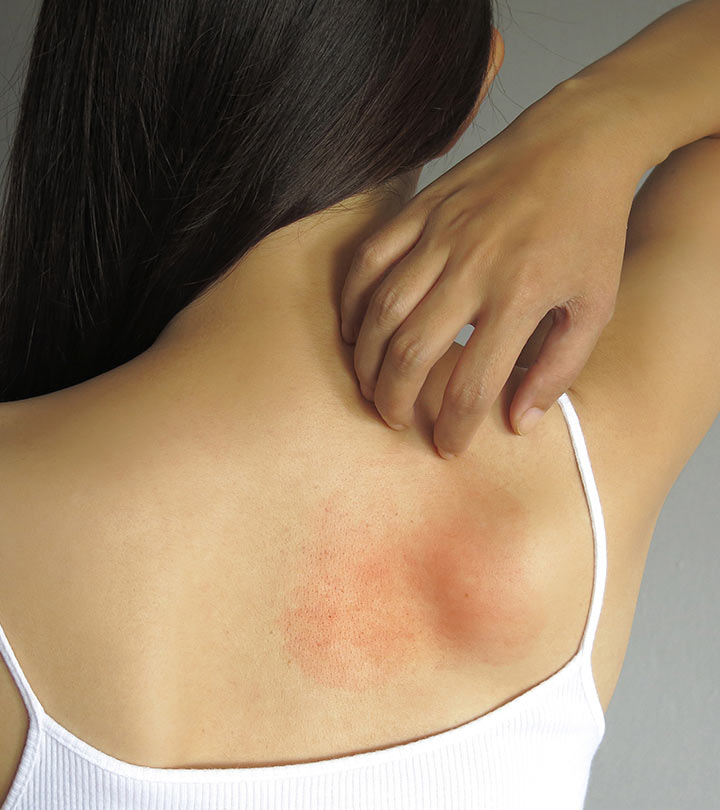 अगर आपको भी पसंद है Tomato Ketchup तो हो जाएं सावधान.... 4 Skin Allergy Symptoms and Home Remedies in Hindi
